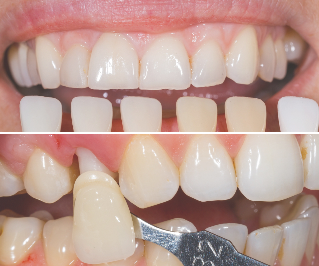 歯をきれいにする審美歯科